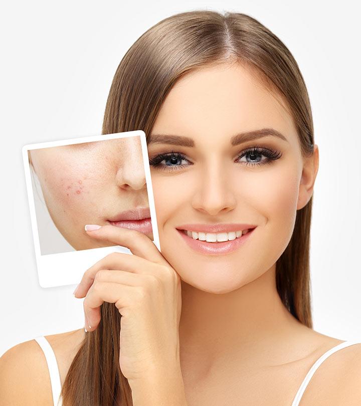 13 Powerful Home Remedies For Acne Healthline