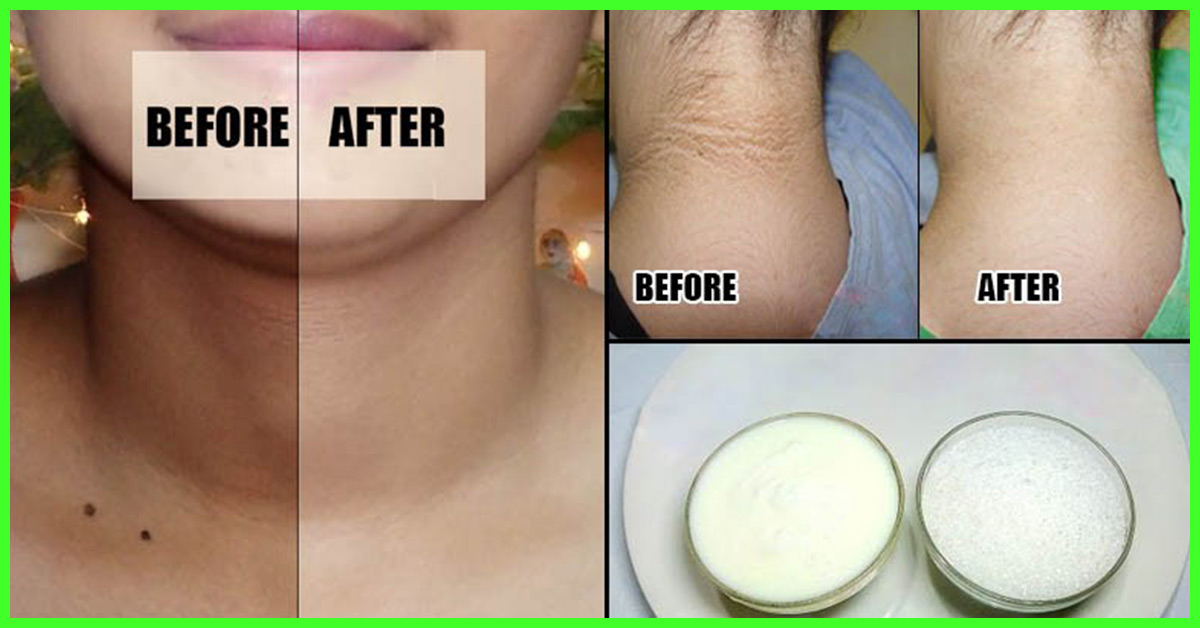 How To Get Rid Of Dark Neck: 12 Effective Home Remedies To Try