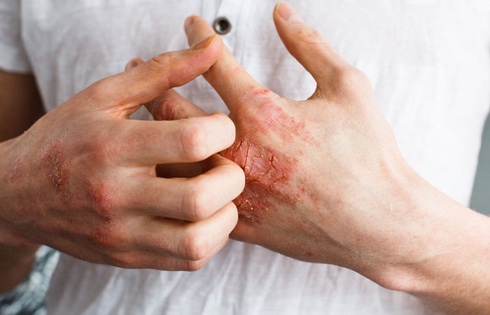 Close up of eczema on hands causing flaky skin
