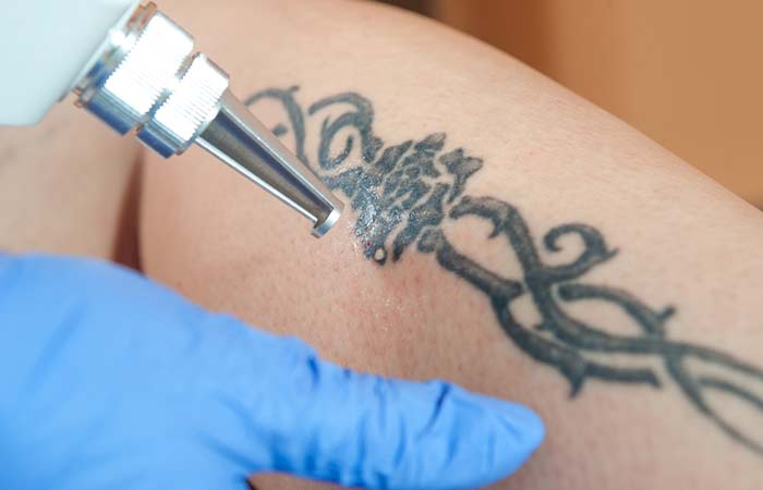 Laser tattoo removal method for permanent tattoos