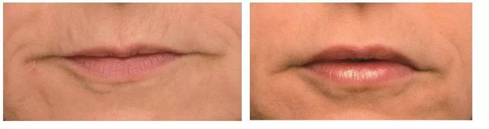 Laser lip rejuvenation to stop lip bleeding