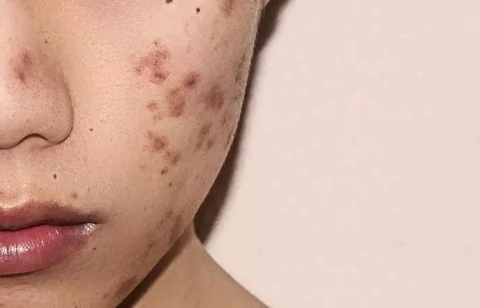 Post-inflammatory hyperpigmentation is a type of hyperpigmentation