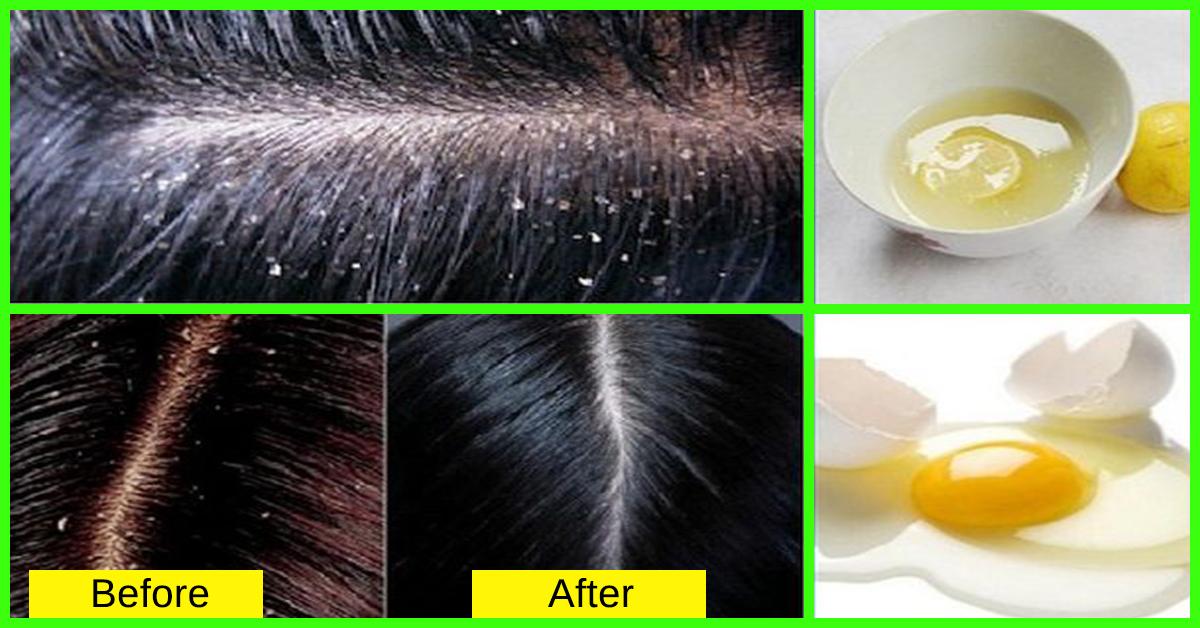 How To Get Rid Of Dandruff Effective Tips And Remedies