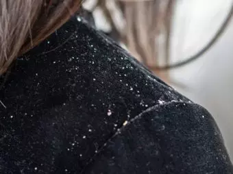 How To Get Rid Of Dandruff Naturally - 18 Tips And Remedies