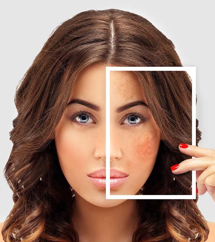 Home Remedies For Pigmentation How To Reduce Dark Spots