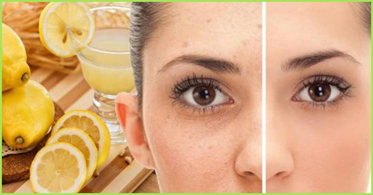18 Simple Ways To Get Rid Of Freckles On Face Permanently 2