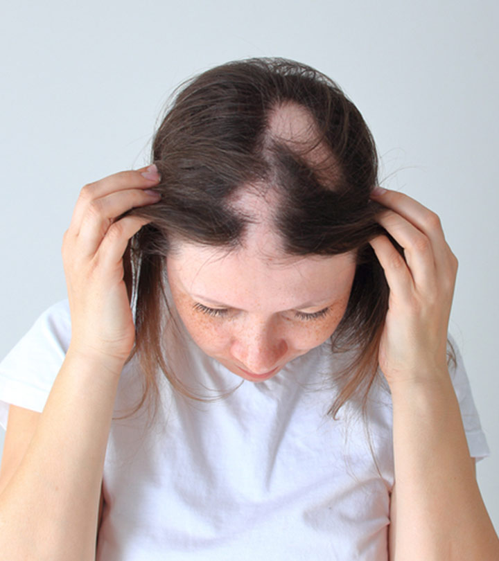Alopecia Treatment: Causes, Treatment, And Prevention