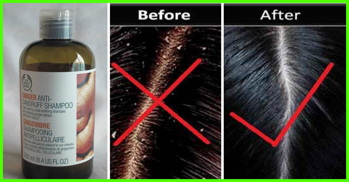 Which is the best anti dandruff shampoo available in India  Quora