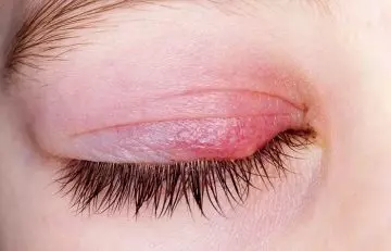 Causes of dandruff on eyelashes and eyebrows