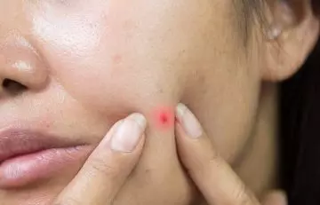 Covering up pimples with concealer