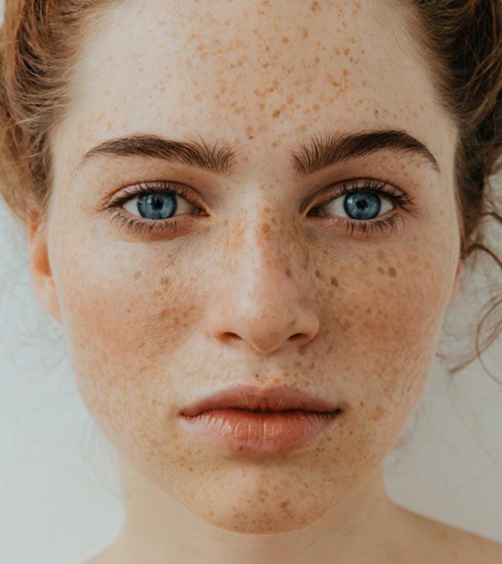 12 Home Remedies For Freckles On Face And Prevention Tips 7667