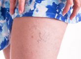 18 Home Remedies To Improve Spider Veins Naturally
