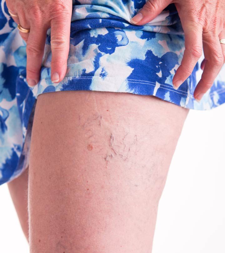 How To Improve Spider Veins Naturally
