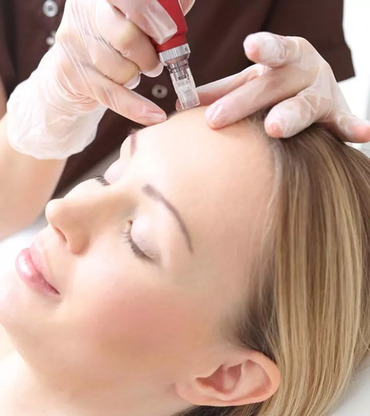 A woman having mesotherapy for hair growth