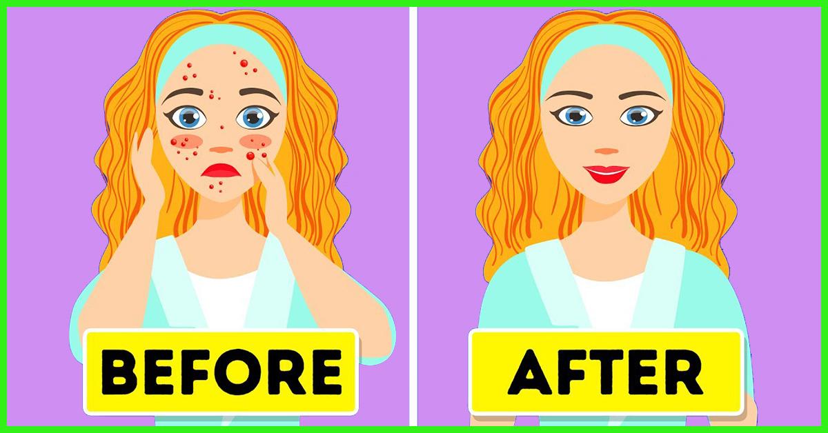 best ayurvedic medicine for acne