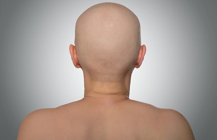 What Are The Different Types Of Alopecia