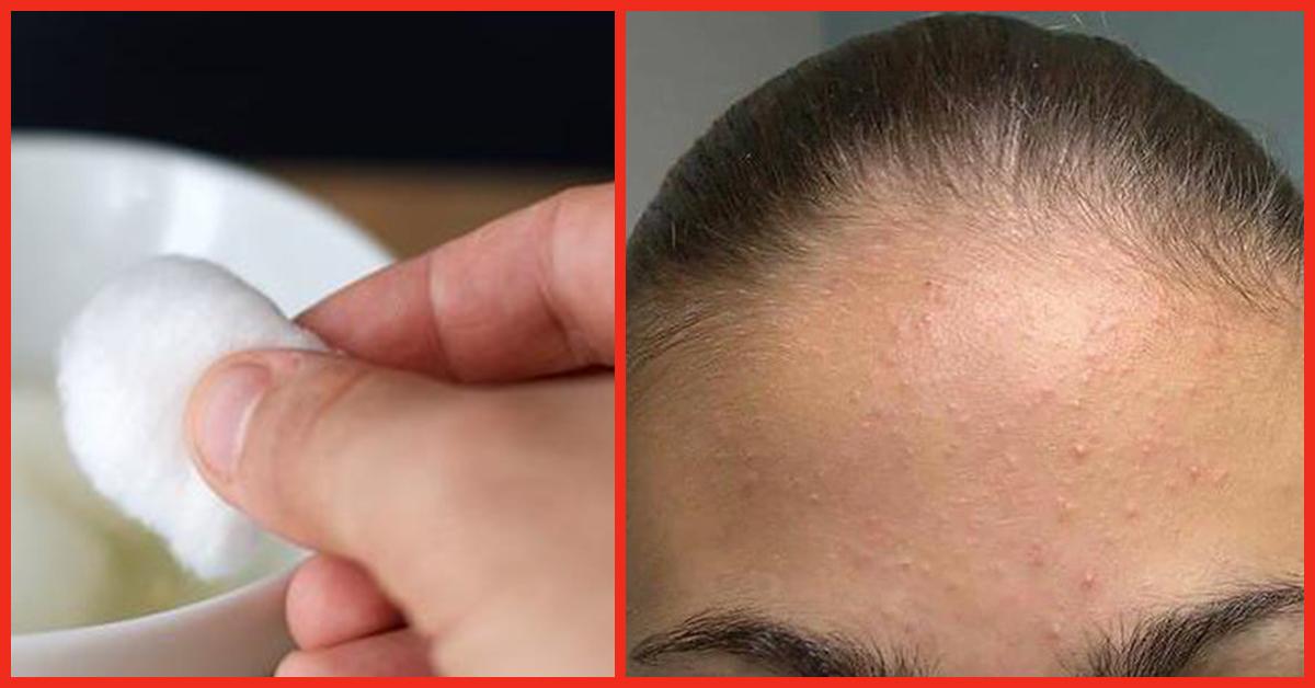 how-to-get-rid-of-forehead-acne-9-home-remedies-to-try