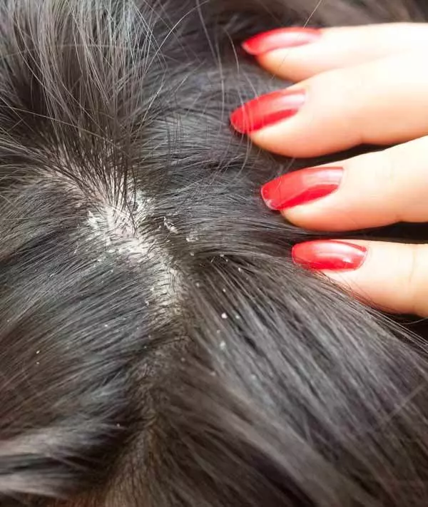 dandruff hair