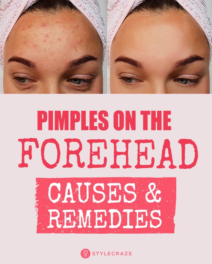 How To Get Rid Of Pimples On Forehead