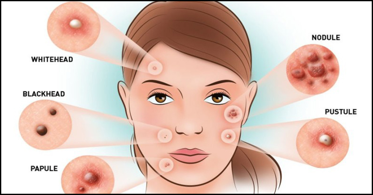 what to prevent acne with