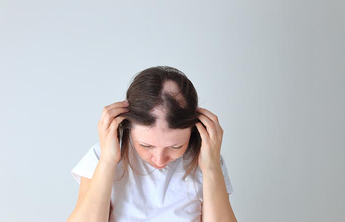 Iron deficiency may cause androgenic alopecia in women