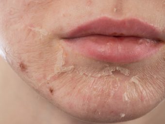 Skin Peeling Causes And Treatments