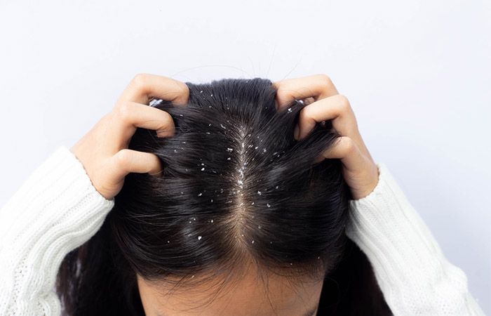 Woman with dandruff and itchy scalp