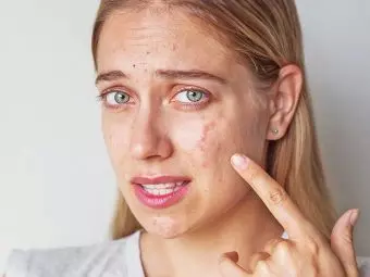 5 Best Home Remedies For Cystic Acne | Causes And Prevention