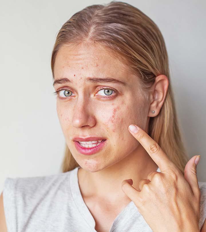 acne caused by toothpaste