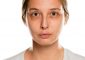 Sunken Eyes: Causes, Remedies, And Tips T...