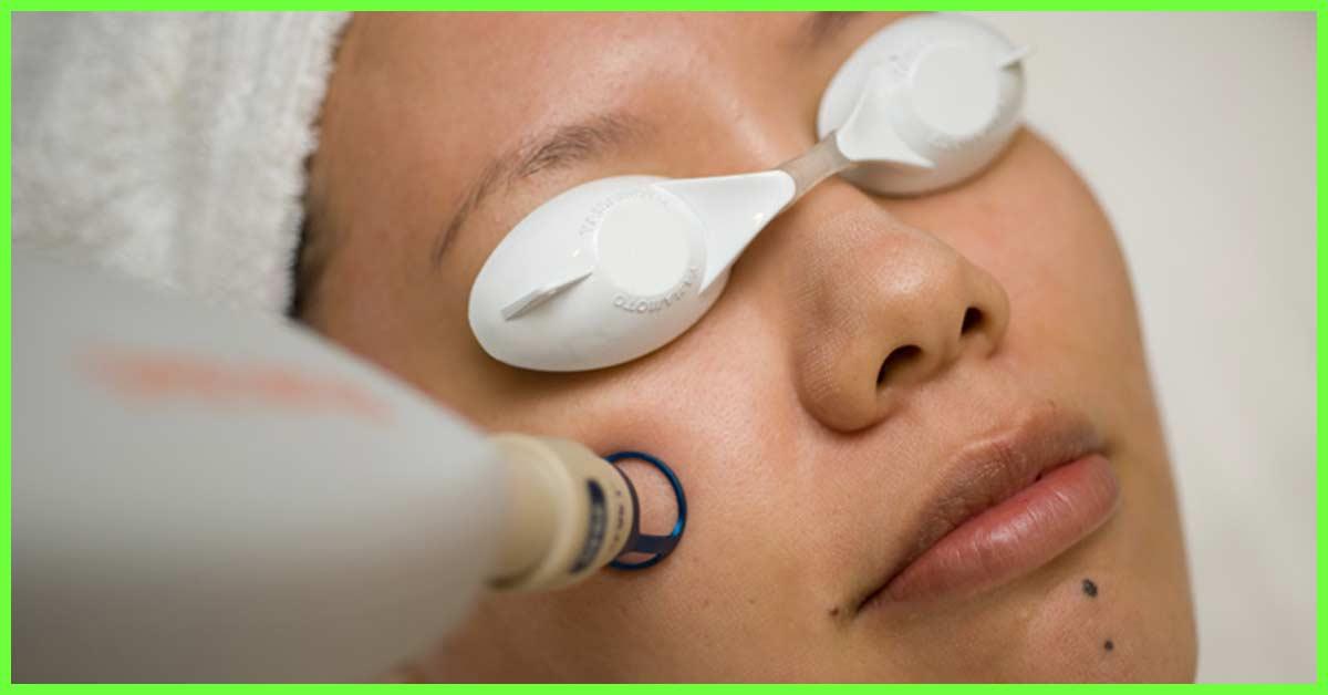 laser treatment for face hair removal