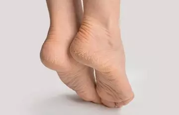 Close-up of dry, cracked heels