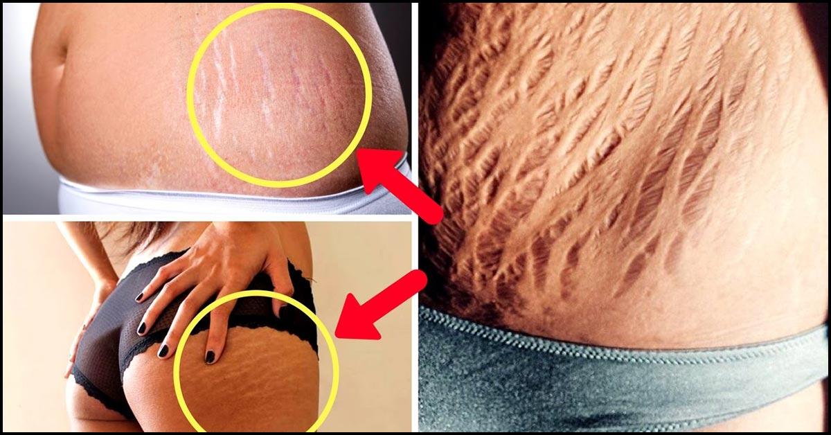 pregnancy stretch marks