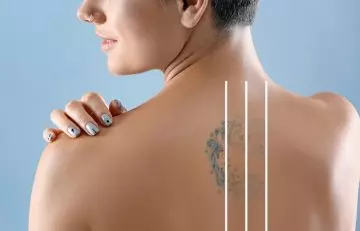 A woman showing her tattoo fading after each session