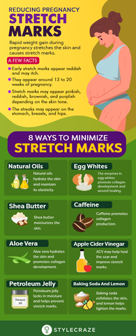 Infographic on ways to remove pregnancy stretch marks