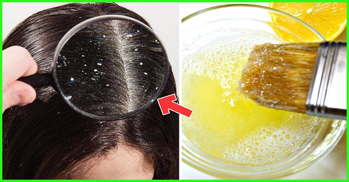 15 Effective Hair Masks For Dandruff