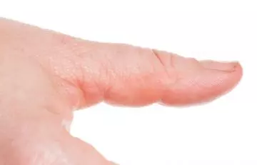Vitamin D deficiency causes koilonychia or spoon nails