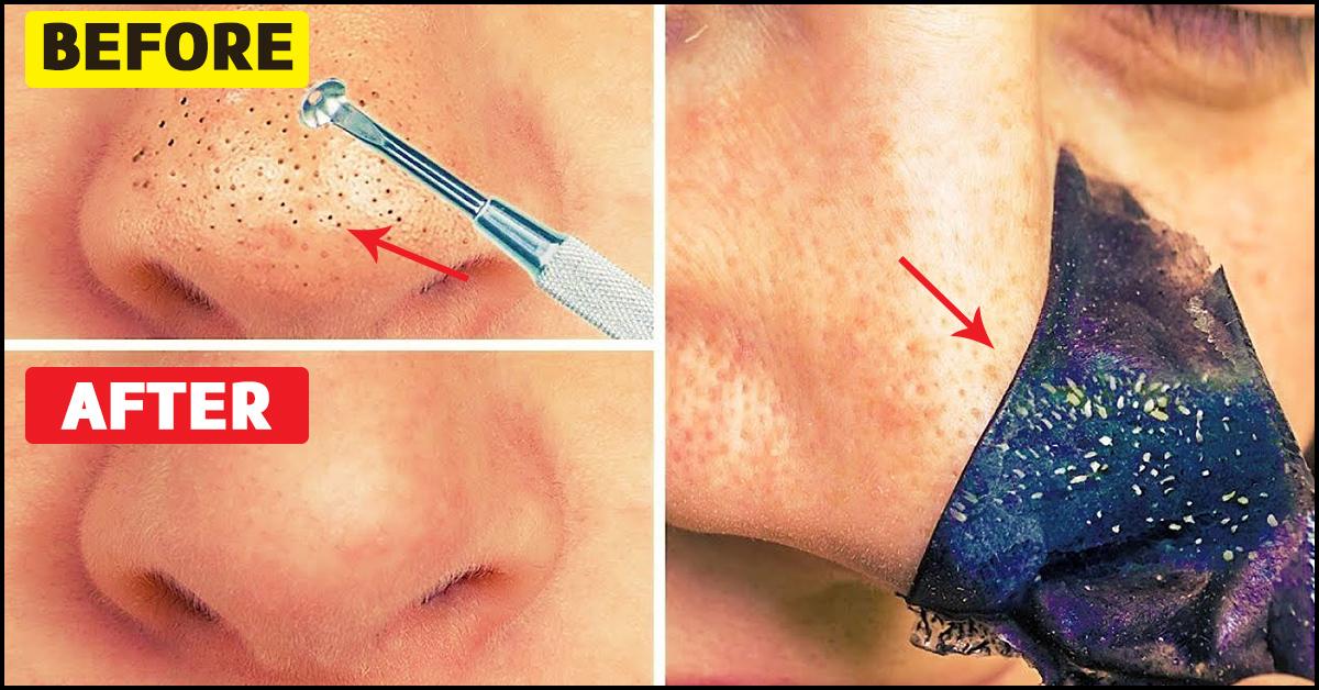 Remove how blackheads to How to