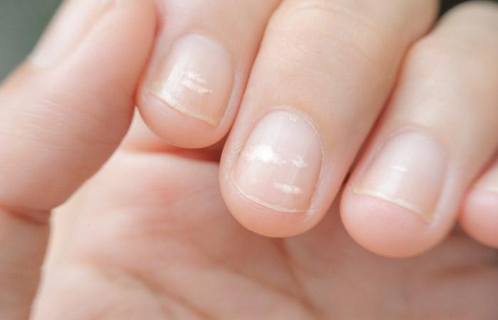 How do vertical lines on my fingernails form? - Quora