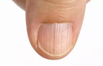 Vitamin D deficiency causes vertical ridging of nails