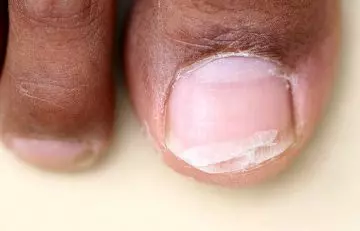 Vitamin D deficiency causes hapalonychia (soft nails)