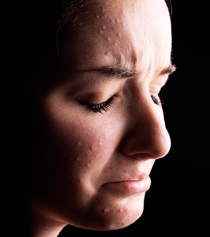 adult acne treatment
