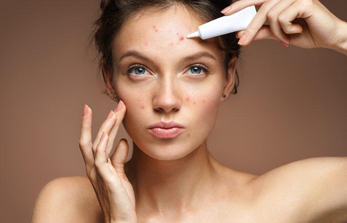 Adult Acne – Causes, Symptoms, And Treatments