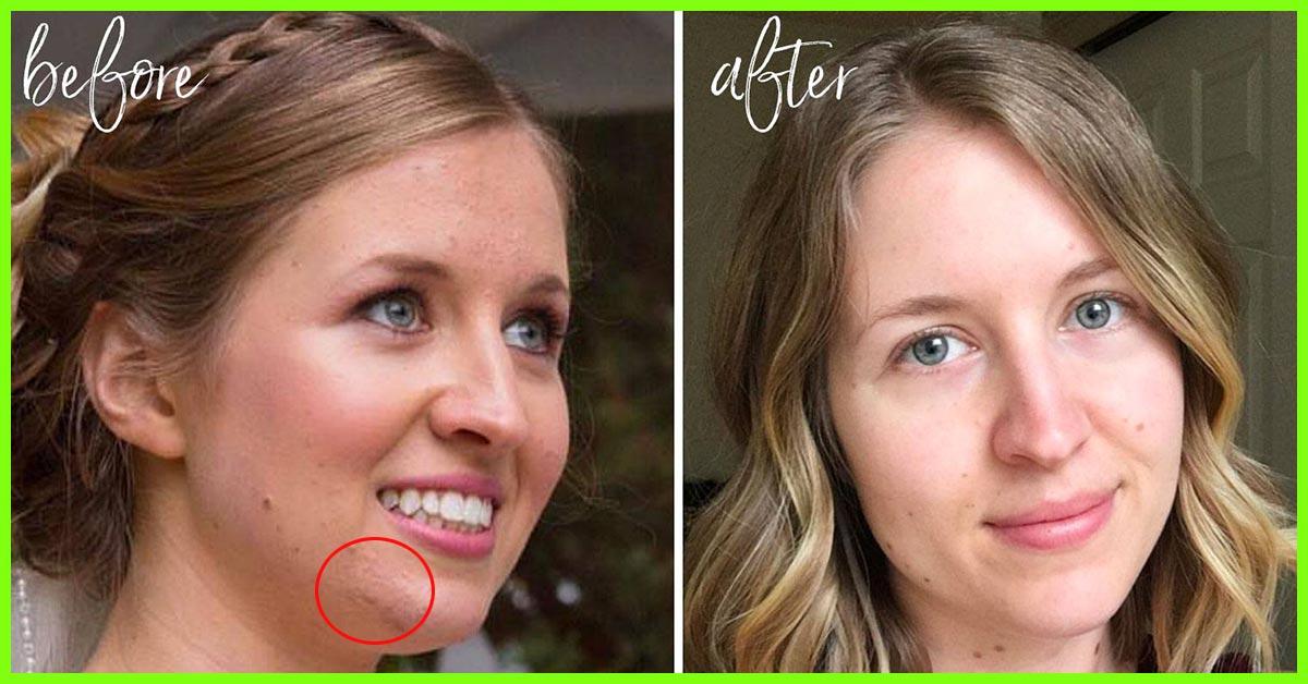 14 Best Acne Face Washes of 2022 Available in India