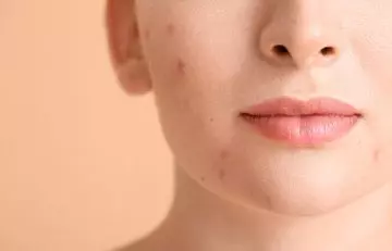 Goji berries may help reduce acne