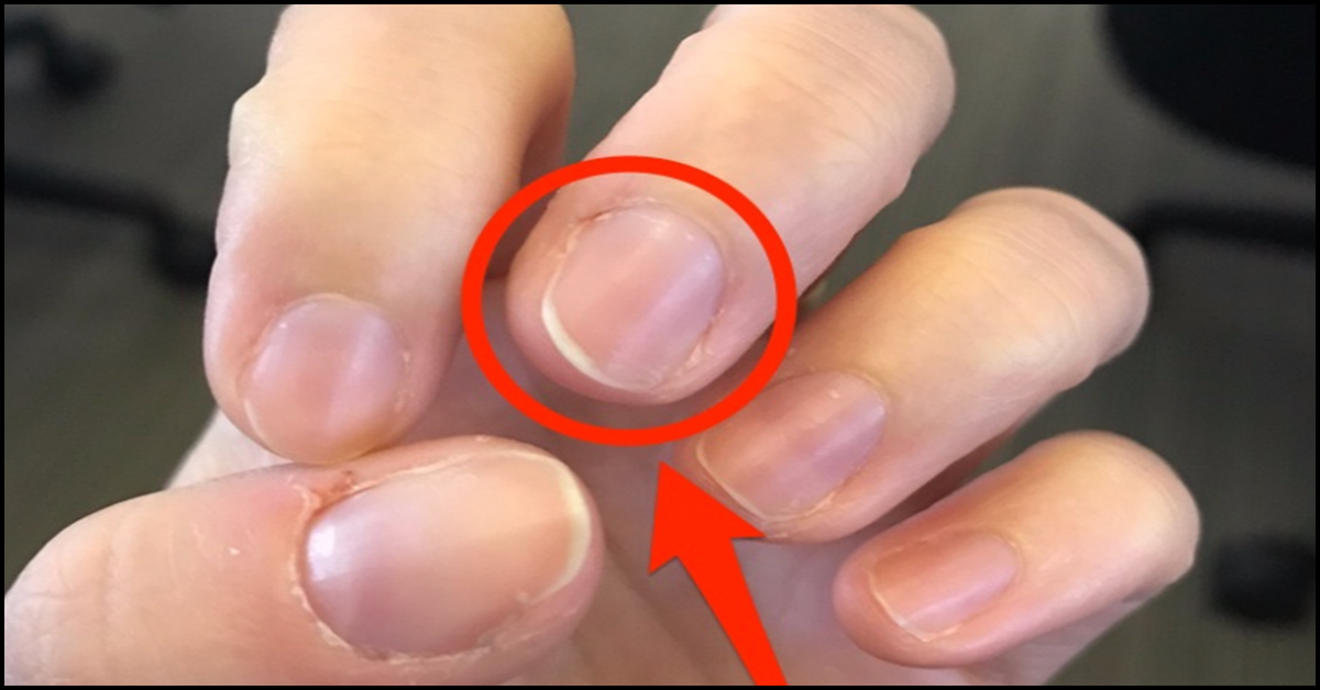 Effects Of Nutrient Deficiency On The Nails: What Do They Indicate