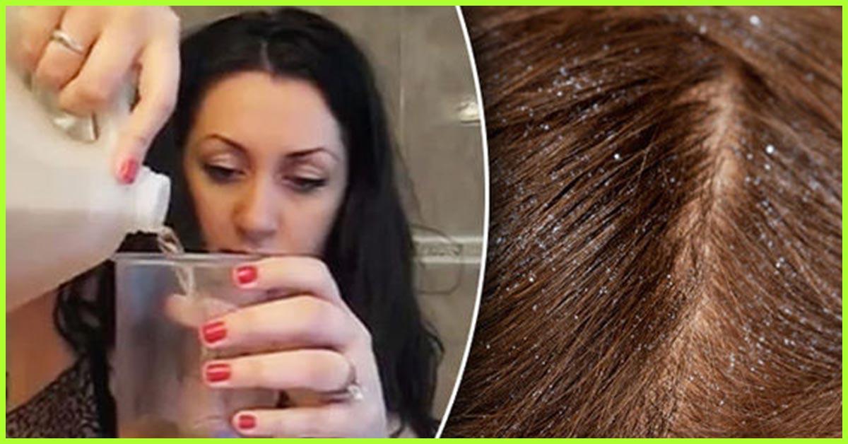 How To Use Apple Cider Vinegar To Cure Dandruff Benefits Side