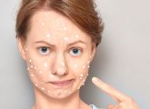 Toothpaste For Pimples: Does It Really Work? - Acne