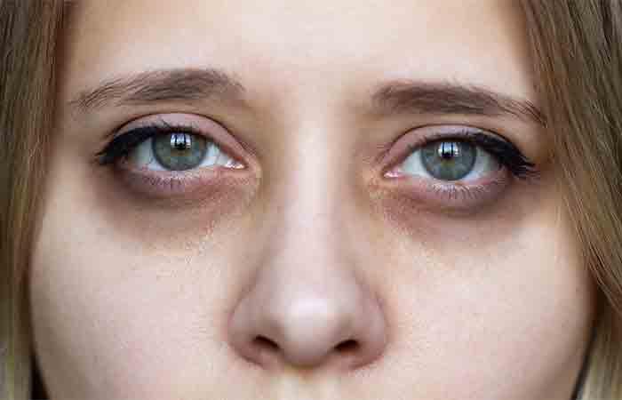 Styes  Chalazion  Symptoms Causes and Treatment  OcuWellness