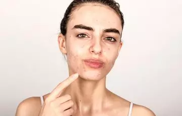 A woman with acne problems